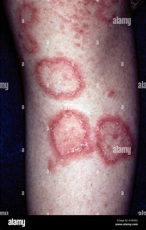 Lupus Skin Rash Stock Photo 3361442 Alamy
