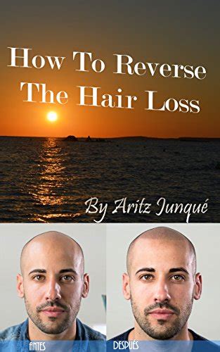 How To Reverse The Hair Loss Hair Loss Hair Loss Cure Minoxidil