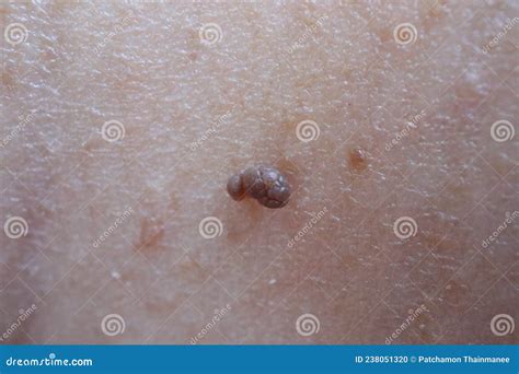 Close Up Of A Mole Or Polyp On A Young Womanand X27s Skin Stock Photo