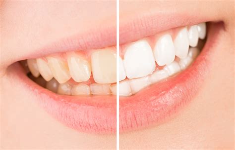 coffee stains teeth what you should know before your next cup newbury dental group