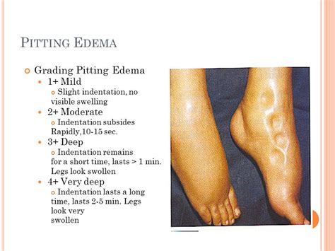 Definition Of Pitting Edema Definition Klw