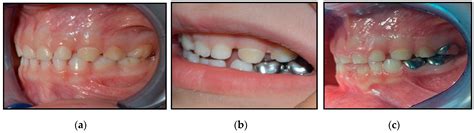 Dentistry Journal Free Full Text Hall Technique For Carious Primary