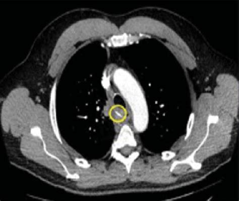 A Cm Radiopaque Metallic Object Adjacent To The Esophagus And Download Scientific