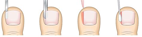 Pioneer Podiatry Ingrowing Toenail Surgery