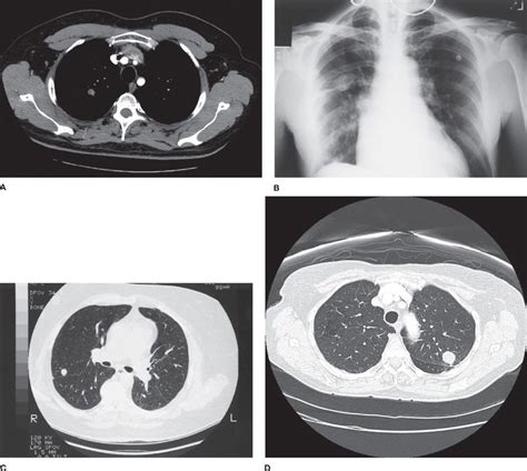 Approach To The Patient With Pulmonary Nodules Thoracic Key