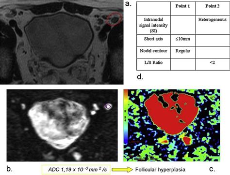 Staging Of Pelvic Lymph Nodes In Patients With Prostate Cancer