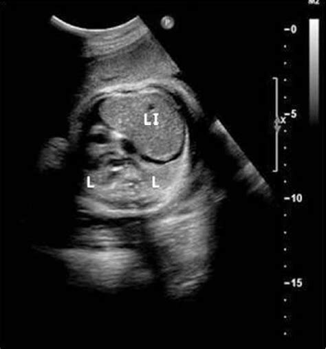 Transverse View Of The Fetal Thorax At 30 Weeks Of Gestation Shows