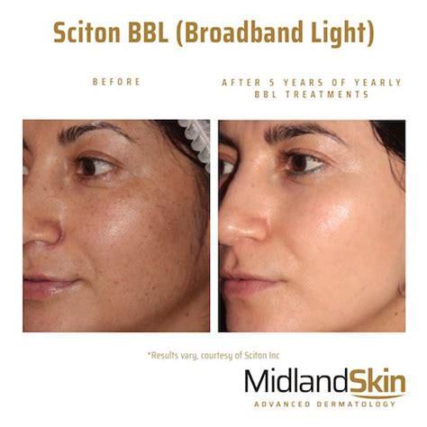 Bbl Broadband Light Midland Skin
