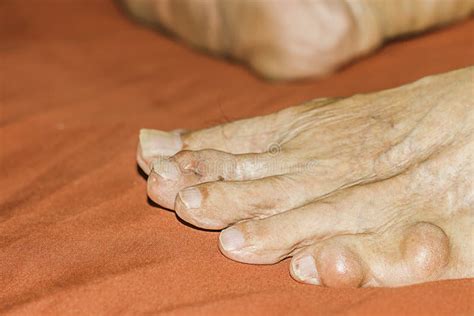 Severe Gout In Men Suffering From Joint Pain Bone Pain Gout
