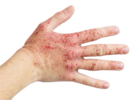 Stress Induced Eczema On Hands