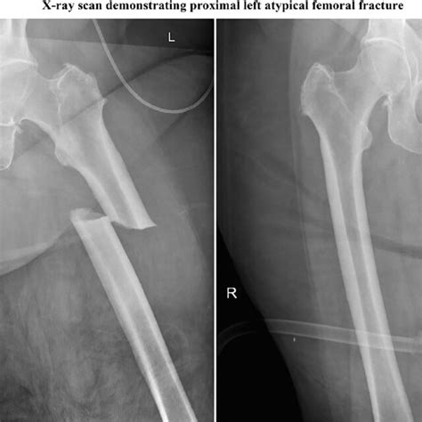 Frontal Projection X Ray Of Left Femur Left Image Demonstrates