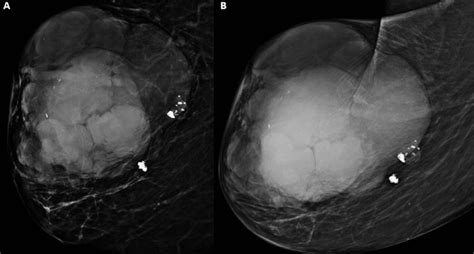 Cureus Giant Phyllodes Tumor In An 82 Year Old Female Initially