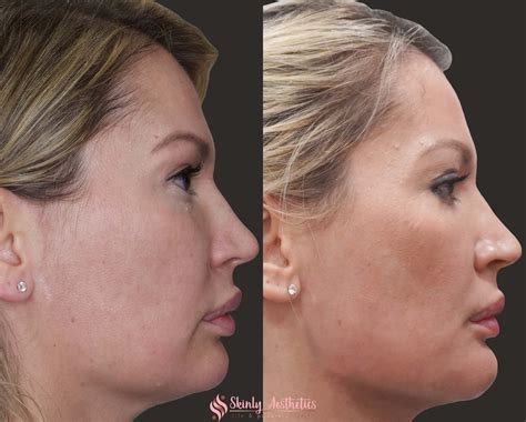 Jawline Fillers Before After Results At Skinly