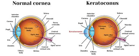 Facts About Cornea And Corneal Diseases Centre For Sight