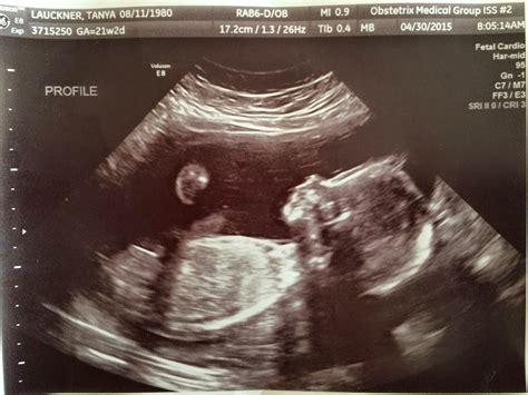 First Comes Love 20 Week Ultrasound