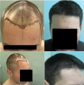 At la fue hair clinic we provide a natural looking and the best fue hair transplant and fue hair restoration services to clients who suffer from hair loss using the latest technique follicular unit extraction fue. Los Angeles Hair Transplant Cost