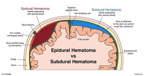 Difference Between Subdural Hematoma And Subarachnoid Hemorrhage My