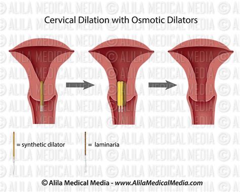 Alila Medical Media Cervical Dilation With Osmotic Dilators Medical