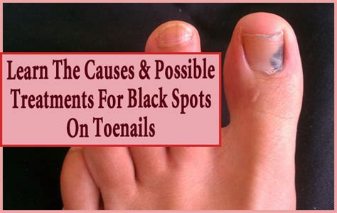 5 Root Causes And Treatment Options For Black Spot On Toenail Black