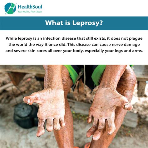 Leprosy: Symptoms and Treatment | Infectious Disease | HealthSoul