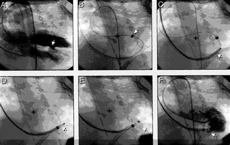 Transcatheter Closure Of Congenital And Acquired Muscular Ventricular