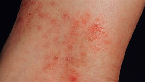 Positive Results With Abrocitinib In Adolescent Atopic Dermatitis Trial
