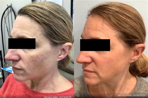 Bbl Before And After Photos Patient 45 Washington Dc Mi Skin Dermatology Center Melda Isaac Md