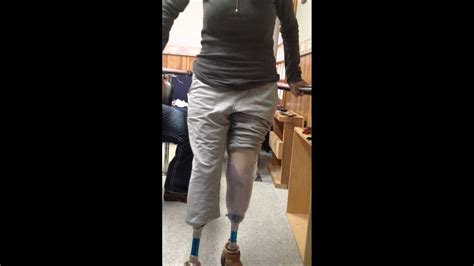 First Time Ever Double Amputee Walking On Prosthetics Handicap