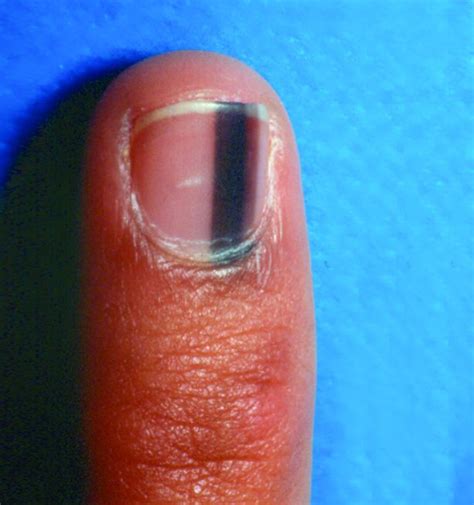 Under The Microscope Skin Cancer Wellness Nails Magazine