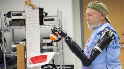 Bilateral Amputee Gets A Pair Of Apls Modular Prosthetic Limbs