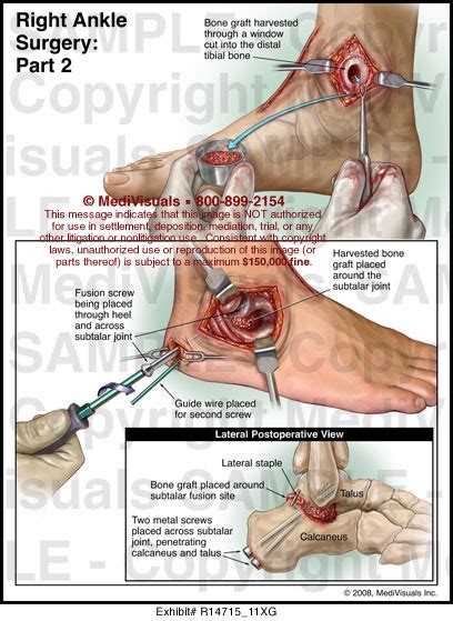 Right Ankle Surgery Part Ii Medivisuals Medical Illustration