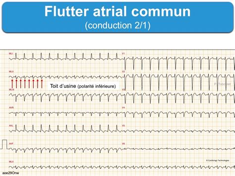 Flutter atrial Généralités e cardiogram