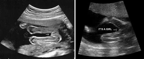 Normal 20 Week Baby Ultrasound Ultrasoundfeminsider