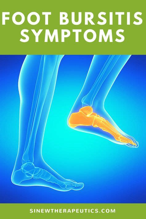 Pin On Foot Bursitis