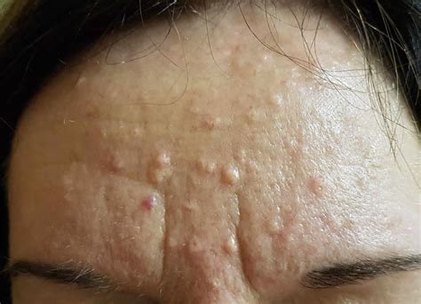 Sebaceous Hyperplasia Treatment And Home Remedies