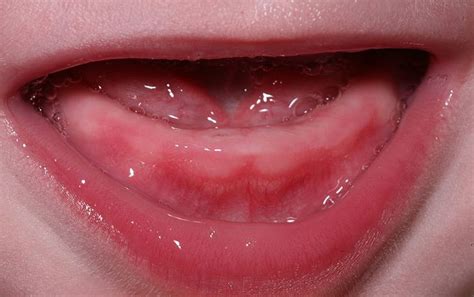 Swollen Gums In Infants 11 Photos How It Looks Naughty Teething