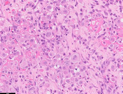 Pathology Outlines Diffuse Malignant Mesothelioma