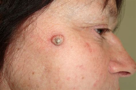 Squamous Cell Carcinoma Symptoms Causes Diagnosis Treatment