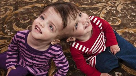 7 Yr Old Twins Share The Same Brain And Can See Through Each Others Eyes