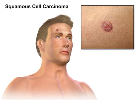 3 Top Skin Cancers How You Can Identify Them By Michael Hunter Md