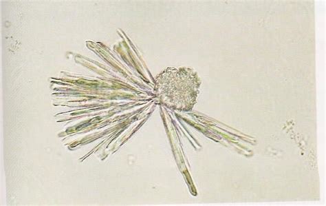 Urates, phosphates and crystals of calcium in the urineare detected by microscopic examination. Calcium phosphate crystals in urine | Medical Laboratories ...