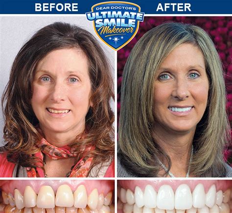 Smile Makeover Contest Winner Sue Cosmetic Dental Makeover
