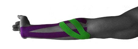 If you are suffering from golfers elbow you are experiencing pain on the top of the forearm close to the elbow. ARES Kinesiology Tape: Golf Elbow