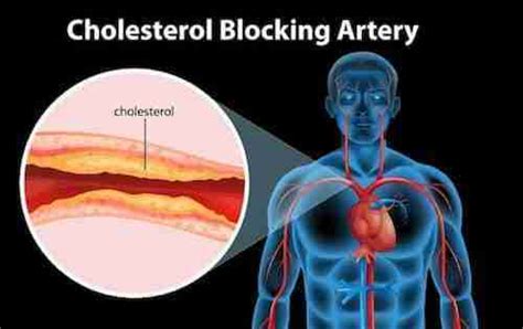 How To Reduce Cholesterol Naturally Without Medicine Just Fitness Hub