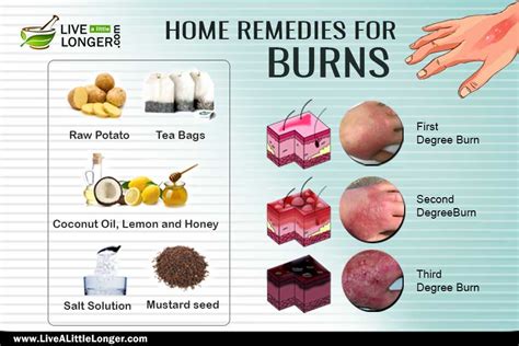 Home Remedies To Treat A Burn Live A Little Longer