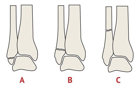 Weber Classification Orthopaedic X Ray Interpretation Medschool