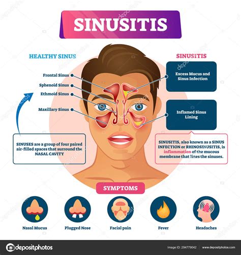 Sinusitis Vector Illustration Labeled Rhinosinusitis Inflammation