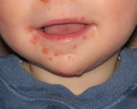Hand Foot And Mouth Disease Hfmd Symptoms And Treatment Medtravel
