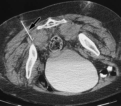 Ct Guided Transgluteal Drainage Of Deep Pelvic Abscesses Indications