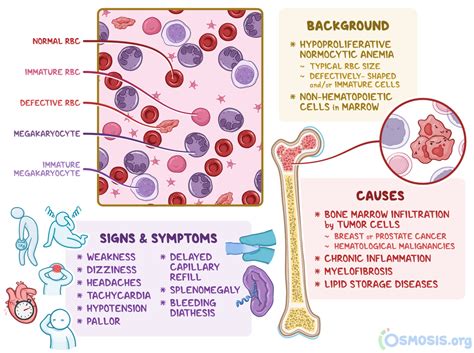 Myelophthisic Anemia What Is It Diagnosis And More Osmosis
